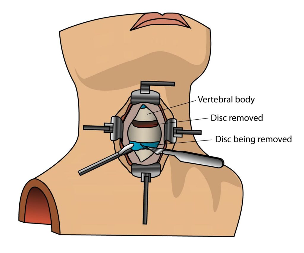 File:ACDF surgery english.png - a diagram of the cervical bone